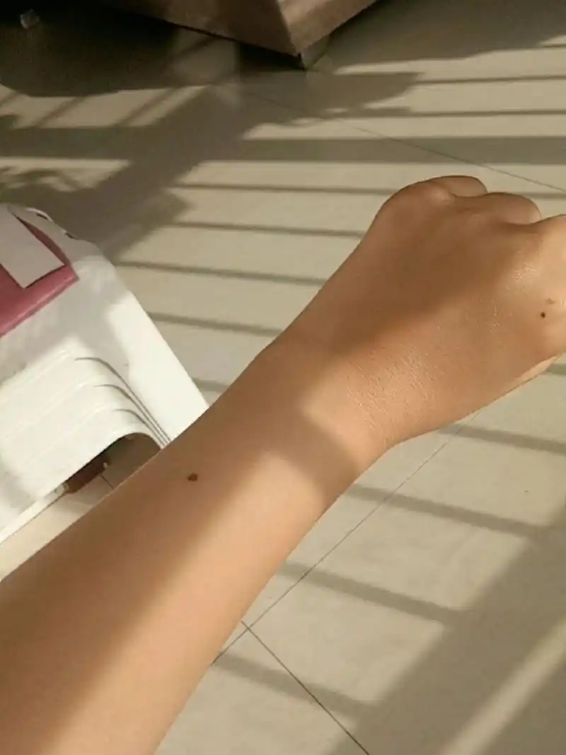 左右手为什么会长痣?