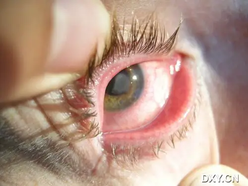 求助一角膜溃疡的诊治. - 眼科专业讨论版 -丁香园论坛