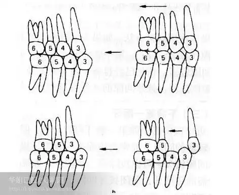 下颌磨牙的近中移动常常需要使用固定矫治装置,使用头帽等增强支抗