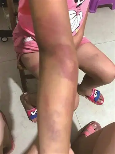 小女孩被打后,大腿,屁股,手臂等处都留下大片大片的紫红斑和青淤斑,惨