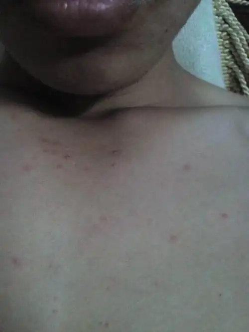 执业医师来自河北邢台人民医院 答: 1,根据你的情况描述,考虑毛囊炎的