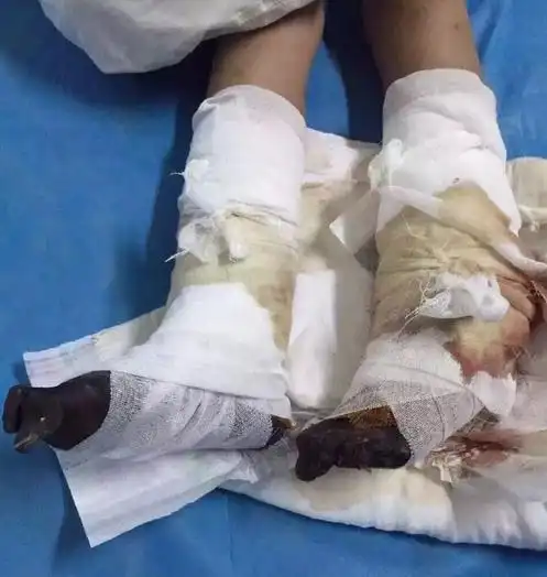 10岁男孩严重烧伤没钱截肢 母亲三年前嫌家穷出走