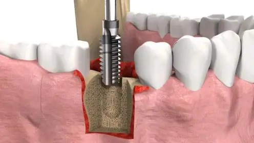 种植牙一期会有失败的情况吗如果失败会有什么样的症状