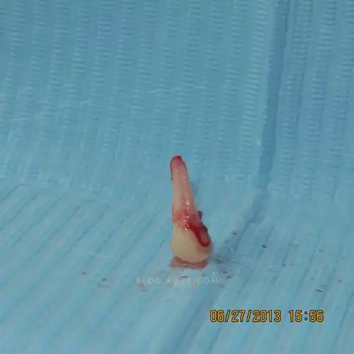 上颌第一双尖牙3牙根屈晓兵