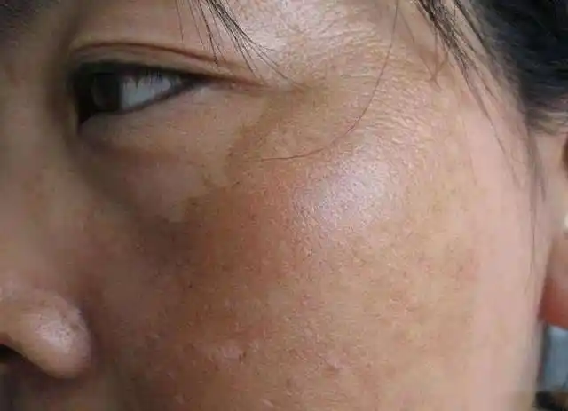 脸上长斑心烦不安便秘干燥中药治肝