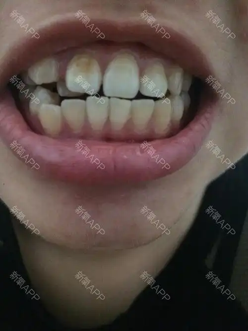目前牙齿歪七八扭,侧面看嘴巴明显往外凸,丑死了,想_圈子-新氧美容