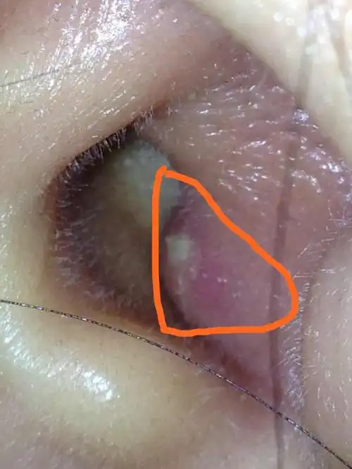 耳朵里长了一个包,是粉刺?,有图片的 ,没什么大碍吧