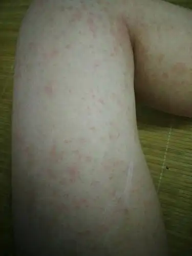全身性的皮肤发洪,有比较密集的红斑,分布在躯干,腿部及手臂,并带有