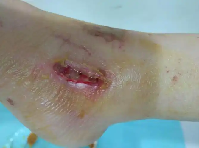 术后指南 | 术后伤口拆线问题_日常护理_日常注意事项 - 好大夫在线