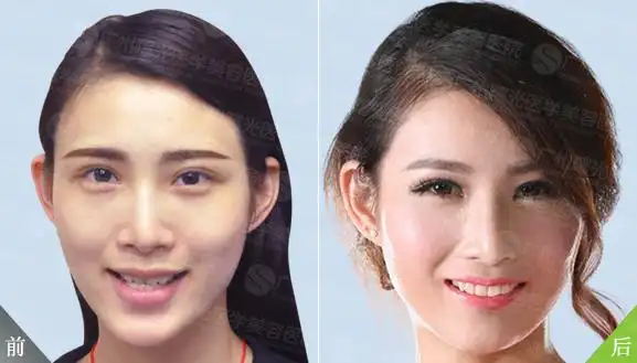 曙光案例_整形美容真实案例_整形美容案例对比图_广州曙光整形美容
