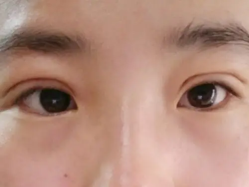 埋线双眼皮失败了?