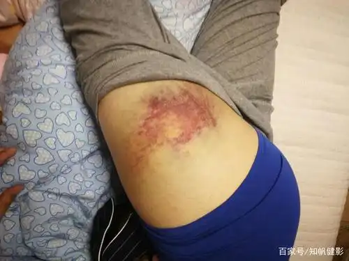 冲击伤的危害有多大?远比你感觉的要严重