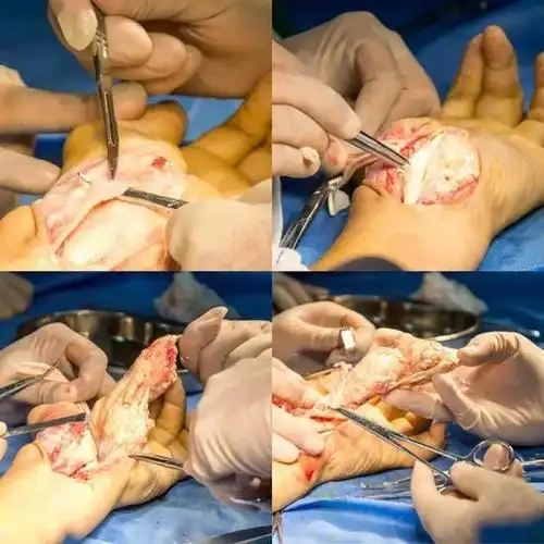 哈医大鸿森医院顺利完成巨大痛风石切除手术