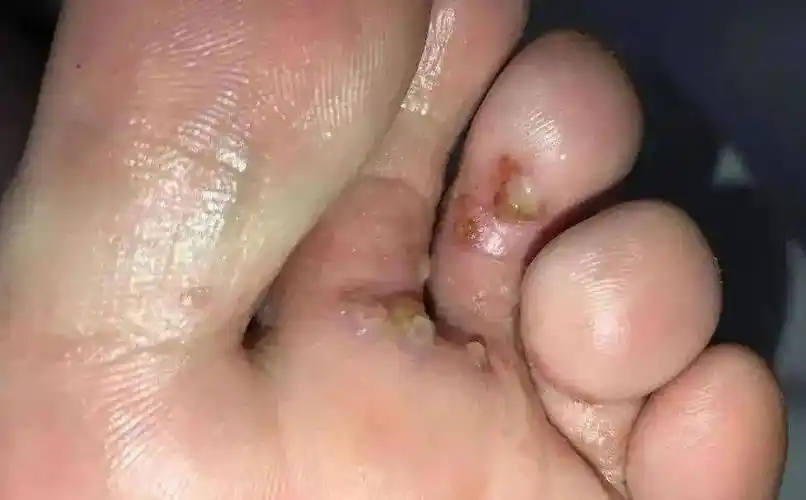 脚臭不是病,脚气需治疗