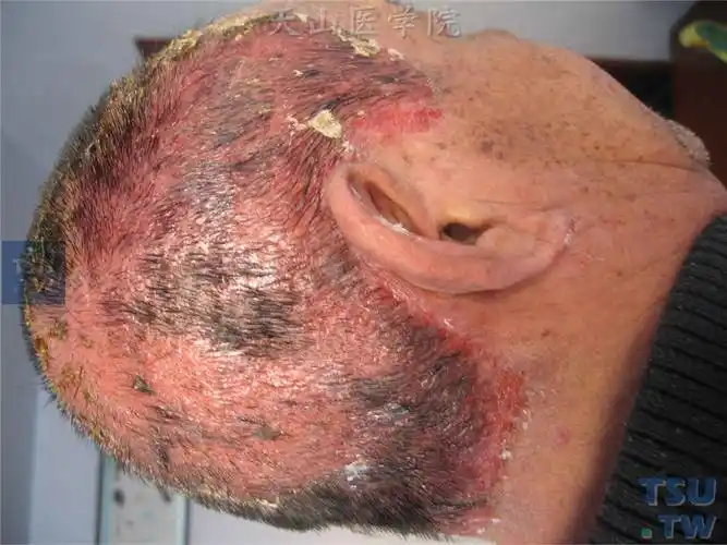 化妆品皮炎cosmeticdermatitis的症状表现