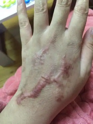 去年出的车祸手上留下了疤,好自卑,快到夏天了我战时不能美容因为年底