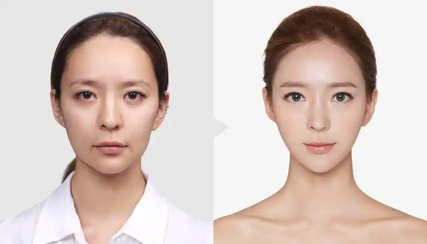 韩国tl脂肪填充案例