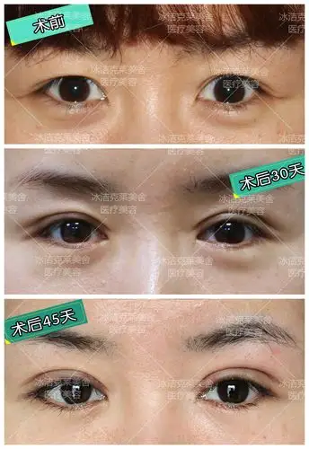 术后一个半月反馈,外眼角 双眼皮效果完全呈现出来,眼神更加媚一些.