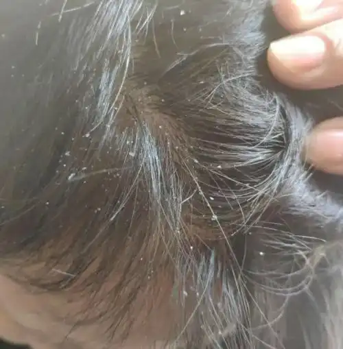 头皮屑多又痒是什么原因 头皮屑多而且特别痒怎么办