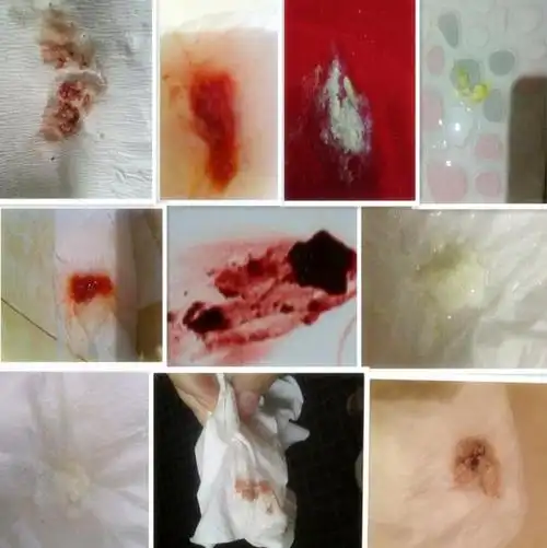 妇科凝胶妇科炎症白带多发黄去异味豆腐渣霉菌性阴道炎外阴止瘙痒1盒