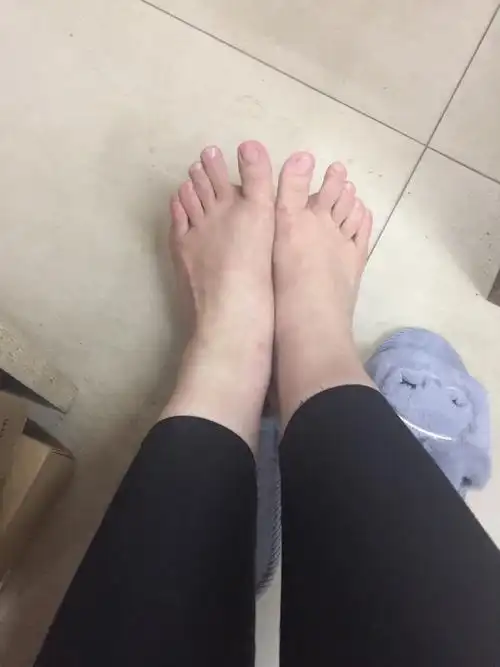 女生脚趾拇外翻是什么样体验? - 知乎