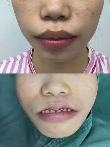 9393上唇m唇 厚唇改薄9393犹豫了很久终于来做了嘴唇_圈子