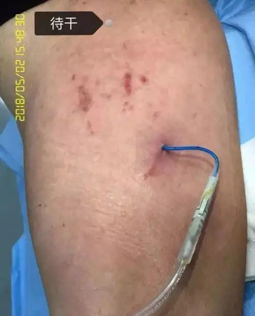 具有较好的吸收性和透气性,可吸收皮肤汗液和穿刺点渗液渗血,防止浸渍