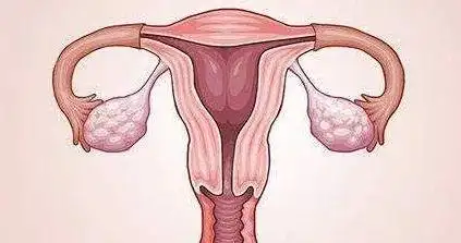 可怕杭州未婚女性子宫内长满38颗肌瘤