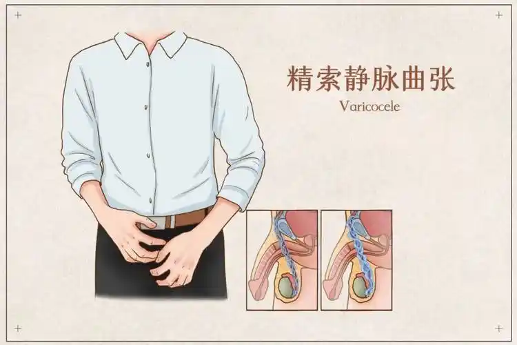 男性不育的冷面杀手——精索静脉曲张_睾丸_阴囊_症状