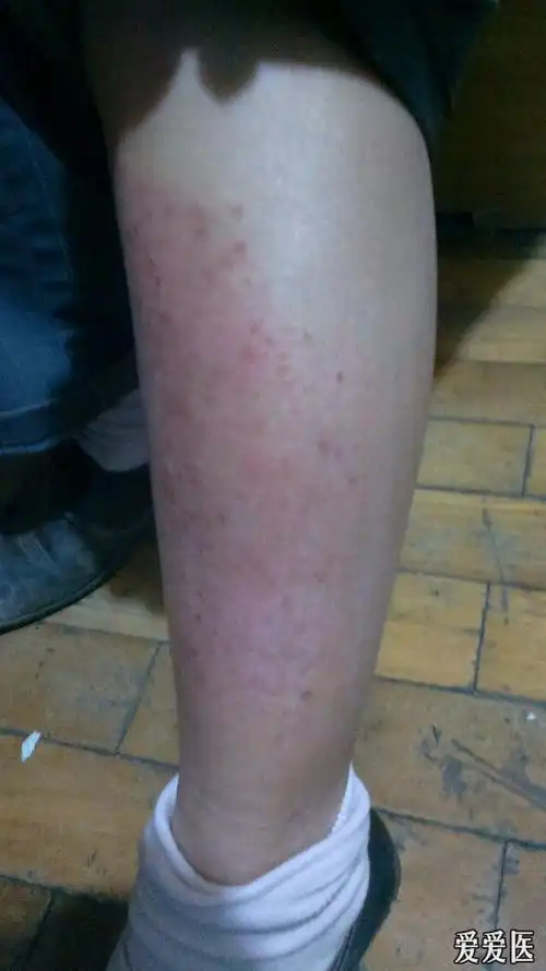 看图识病胫前黑斑
