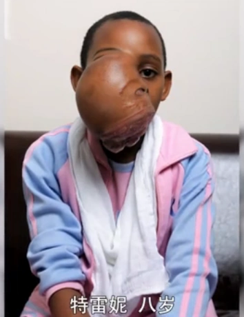 8岁女孩脸上长了个肉球 医生说出真相后 让母亲彻底失望了