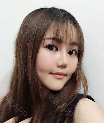 自体脂肪全脸填充好不好_效果图_桃子自体脂肪全脸填充术后第75天