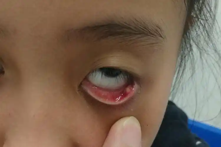 眼疖子图片_有来医生