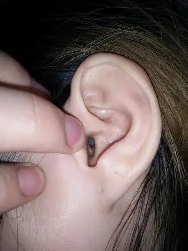 耳朵里长了个这么个东西是什么?放大看