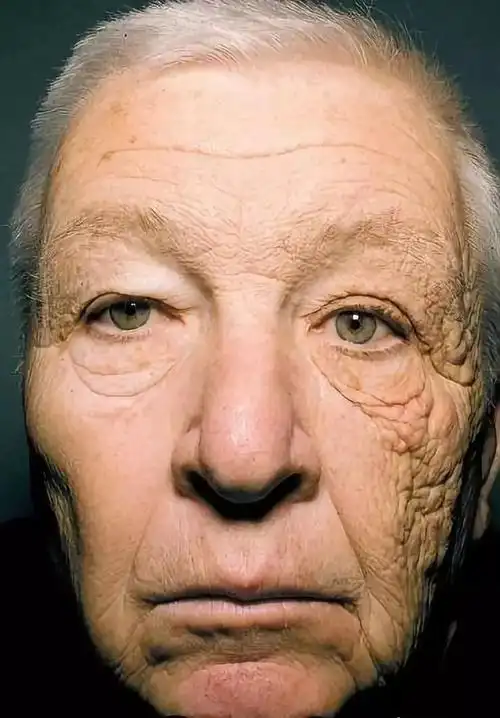 皮肤由三部分组成:表皮层,真皮层,皮下组织.