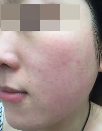 分享我的敏感皮肤红血丝修复经历