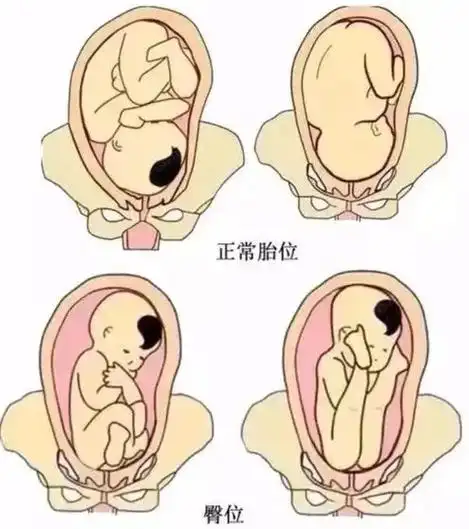 臀位外倒转术指的是在妊娠足月,用手法将臀位的胎儿转为头位的技术.