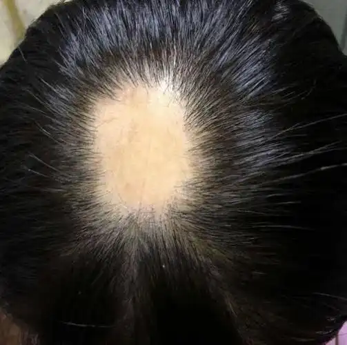 经过面诊,检查,陈欢医生初步诊断,小林的脱发症状是典型的 斑秃.