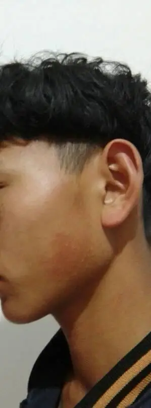 脸侧面那黑色的是什么玩意,4年前慢慢出现在脸上的,有什么方法去掉.