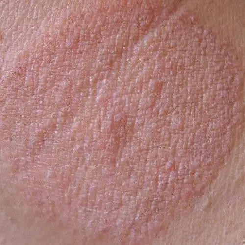 关于体癣的早期症状表现特点