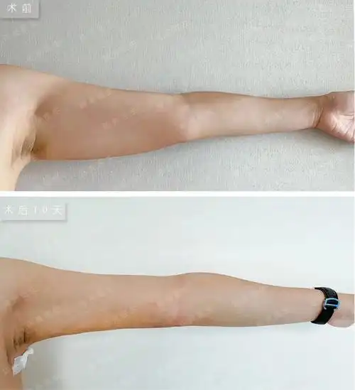 科普吸脂手术会导致皮肤松弛吗