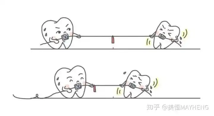 很多人去做牙齿矫正之前都听过这句,"牙齿矫正一怕拔牙,二怕打骨钉