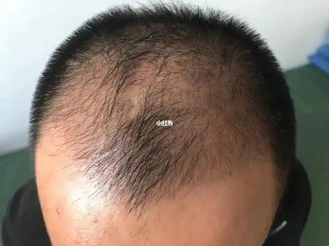 才30岁脱发严重2个月肉眼可见长了好多头发