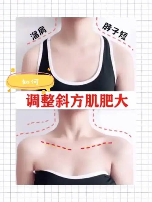 斜方肌粗大,想要体态好可以尝试瘦肩针~夏季到了,很_圈子-新氧美容