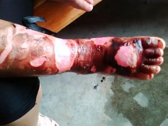 烫伤疮面颜色暗红是三度图片