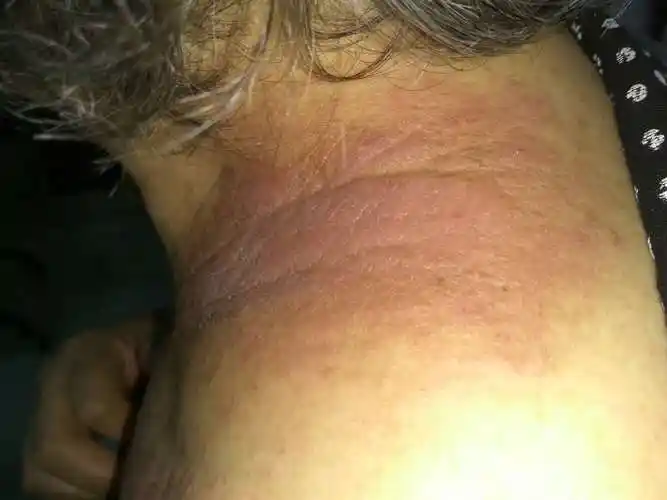 病史:女,81,颈部反复发作性皮疹3年,痒.