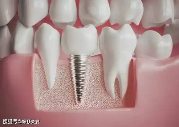 武汉口腔医院中诺口碑排名哪些人做种植牙需要填骨粉