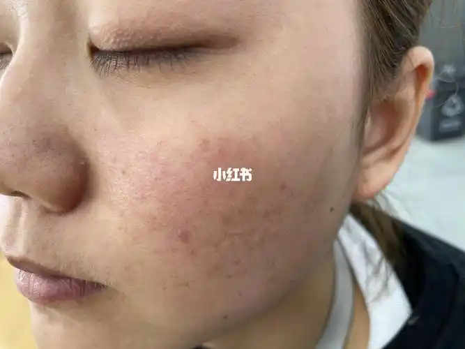 基底层验证_敏感肌_红血丝修复_修复红血丝敏感肌_美妆_护肤_护肤其他