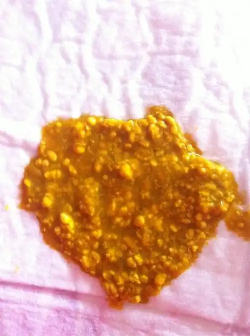 大量血便,不是有血丝,而是整个大便呈果酱色 3.