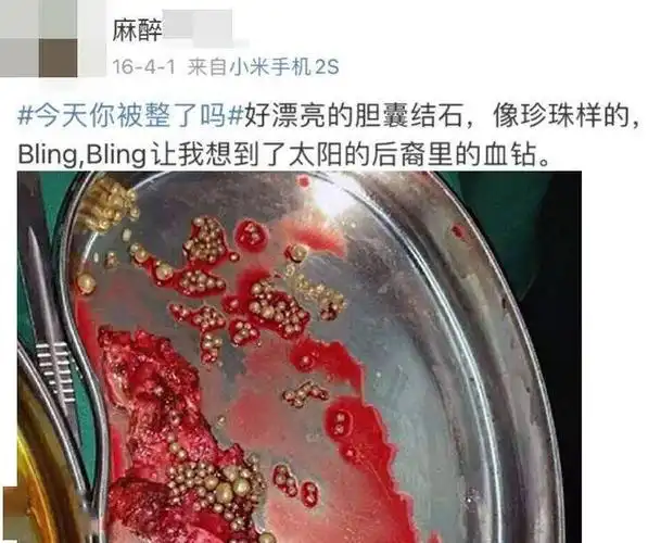 左右滑动查看更多(恐血者止步)>>>脏器结石形成的人体珍珠过于血腥